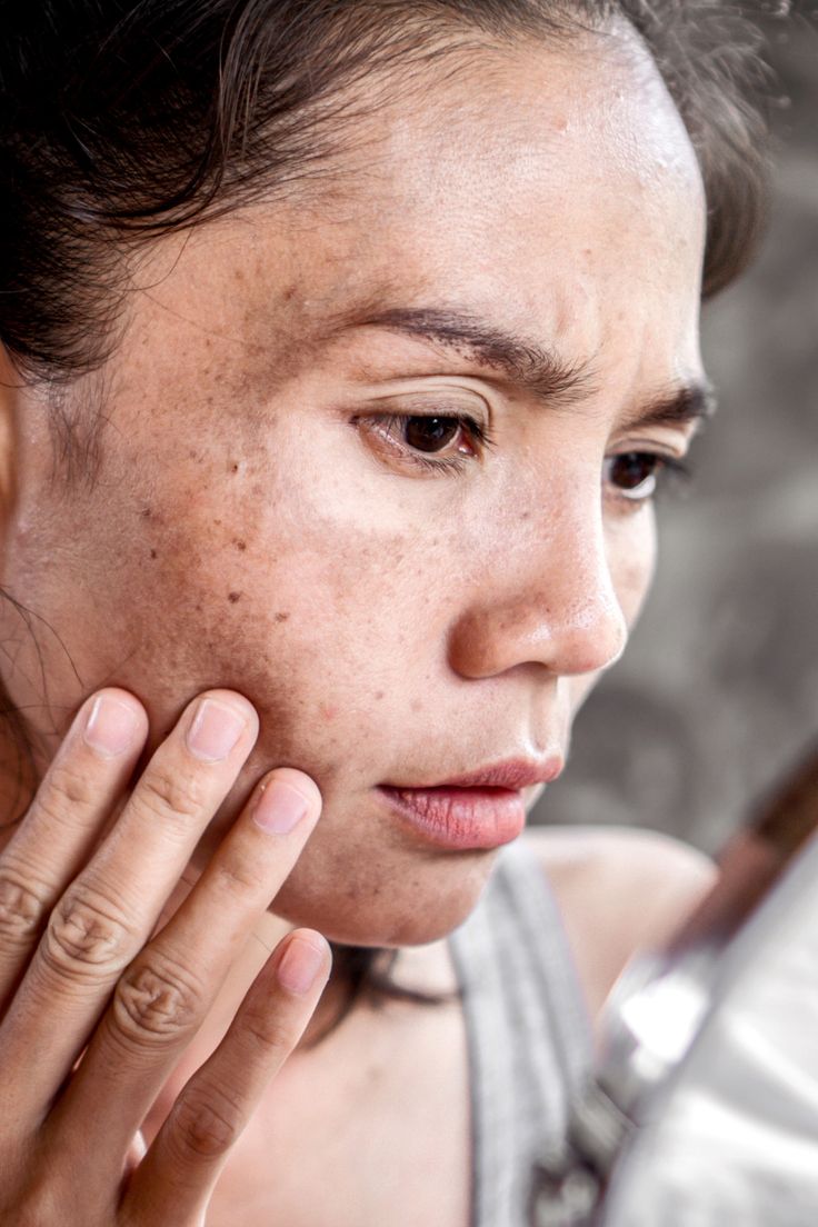 Da tuổi 40 nhiều nám