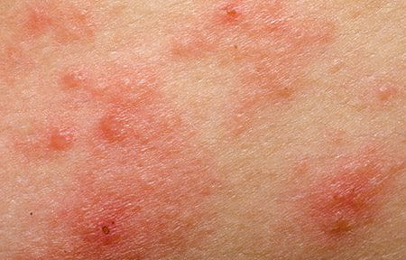 Khi độ pH của da bị suy giảm, da dễ bị nhiễm trùng